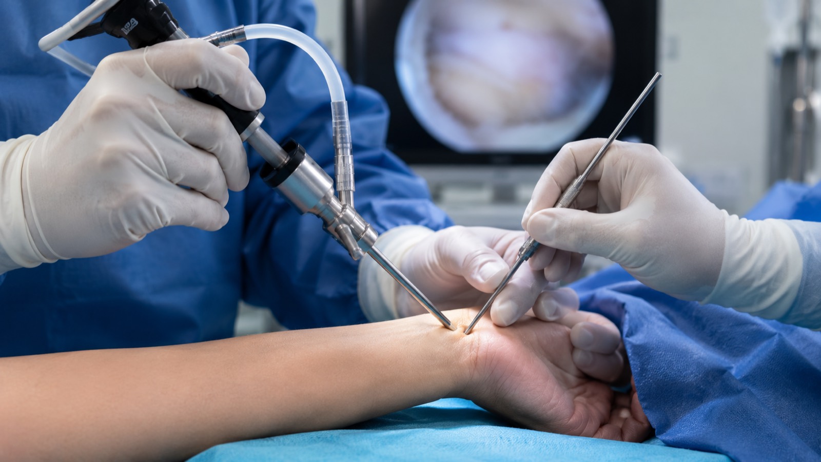 Canal carpien endoscopique mini-open technique