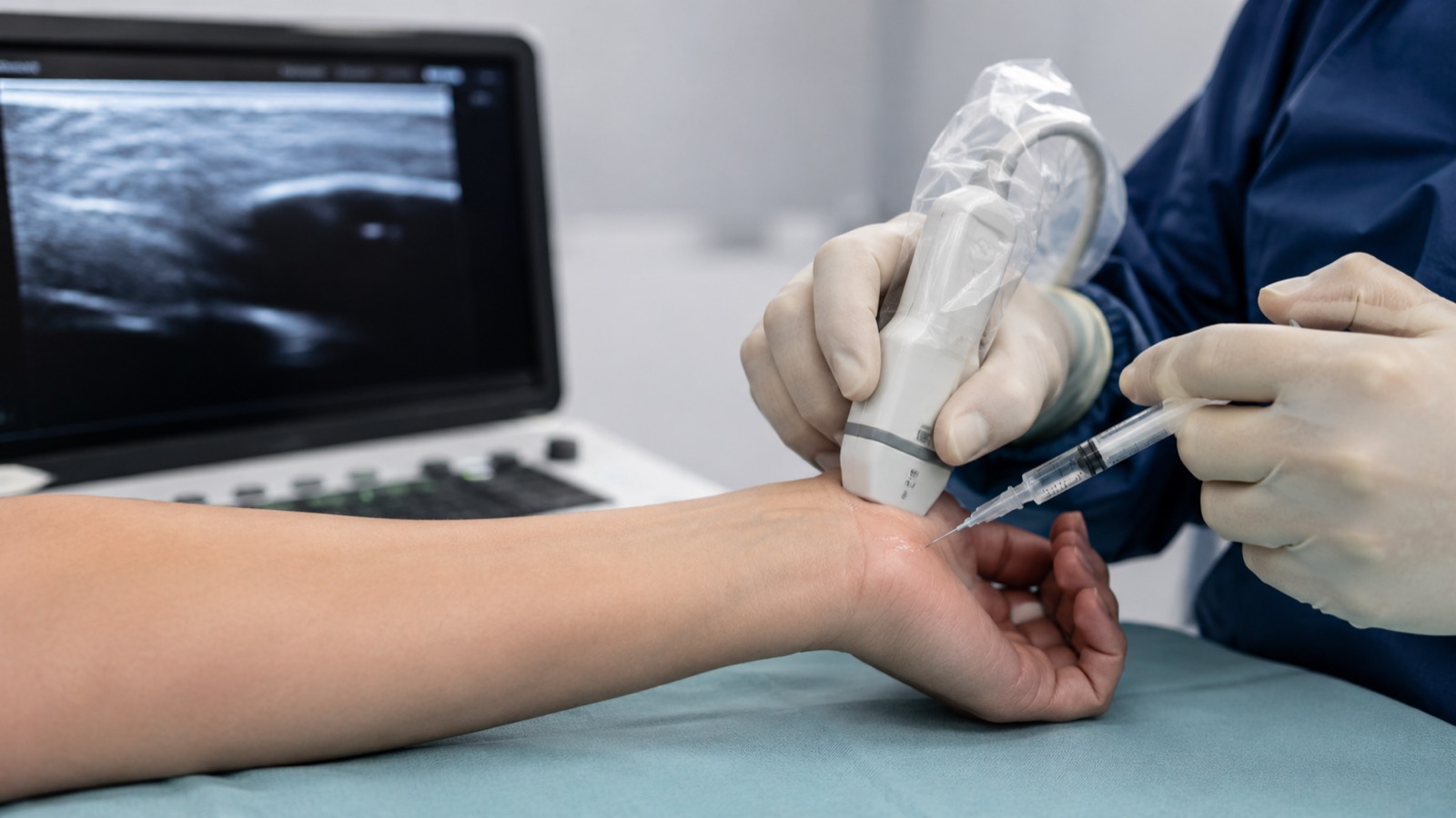 Technique WALANT chirurgie sans anesthésie générale